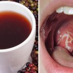 Strep Throat: 10 Natural Remedies