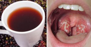 Read more about the article Strep Throat: 10 Natural Remedies