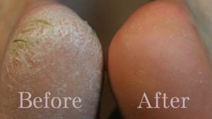 Read more about the article How To Clean Your Feet With Baking Soda? It’s Very Easy. Try This, The Results Are Incredible!