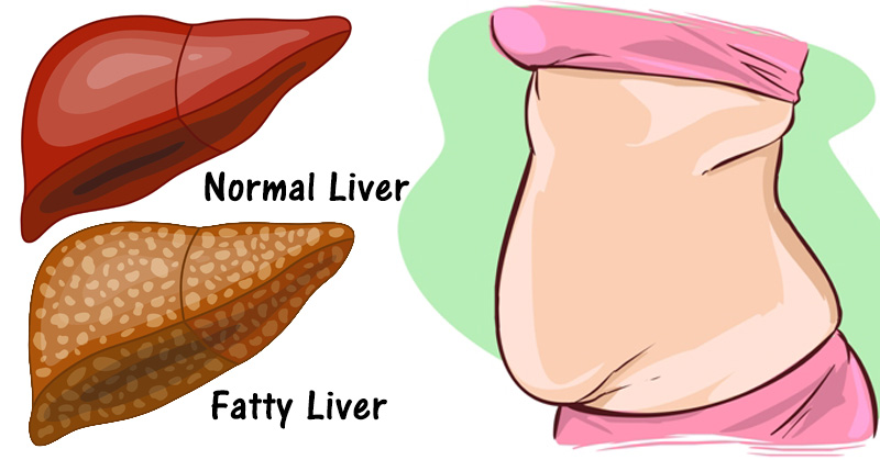 You are currently viewing 5 Warning Signs That Your Have Liver Full Of Toxins That Make You Gain Weight (And How To Stop It)