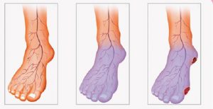 Read more about the article Poor Blood Circulation, Cold Hands and Legs? Here is What You Can Do to Solve This Problem