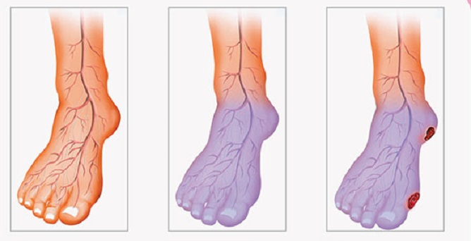 You are currently viewing Poor Blood Circulation, Cold Hands and Legs? Here is What You Can Do to Solve This Problem