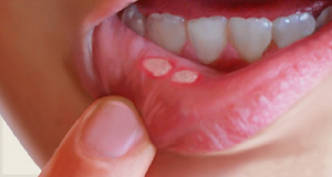 Read more about the article Canker Sores In The Mouth: Here Is How To Naturally Get Rid Of Them In Just One Day Without Using Any Medicine