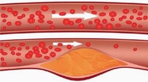 Read more about the article Take 4 Tablespoons Of This Every Morning And Say Goodbye To Clogged Arteries, High Blood Pressure, And Bad Cholesterol!