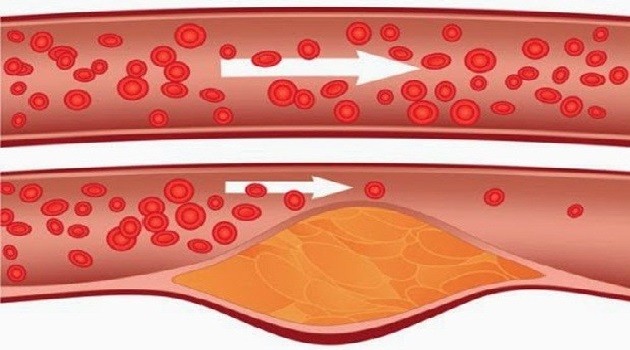 You are currently viewing Take 4 Tablespoons Of This Every Morning And Say Goodbye To Clogged Arteries, High Blood Pressure, And Bad Cholesterol!