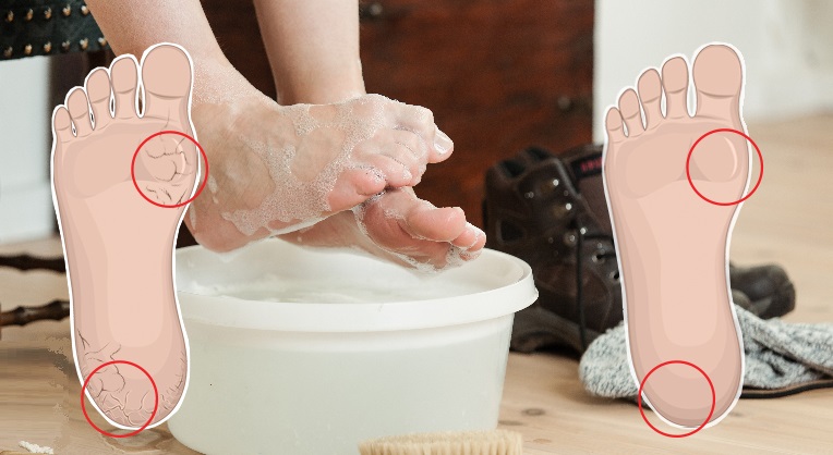 You are currently viewing Soak Your Feet in This Powerful Baking Soda Mixture 2x Each Week To Heal Dry And Cracked Feet