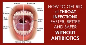 Read more about the article 12 Effective Natural Home Remedies To Treat A Strep Throat Infection