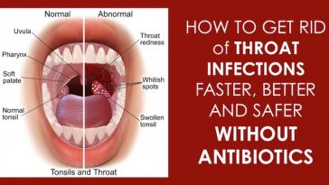 Strep Throat Infection