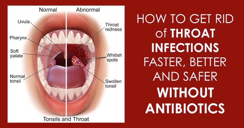 You are currently viewing 12 Effective Natural Home Remedies To Treat A Strep Throat Infection