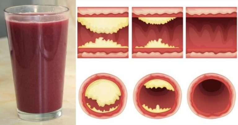 You are currently viewing This Delicious Juice Will Unclog Arteries and Prevent Heart Disease!