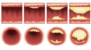 Read more about the article Top 6 Foods That Naturally Unclog Arteries and Prevent Heart Attacks