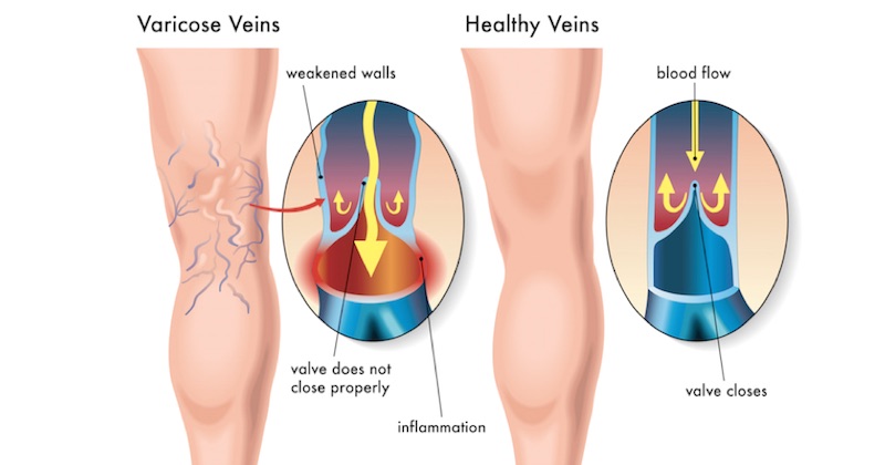 You are currently viewing 10 Natural Ingredients That Help Improve Blood Circulation and Prevent Varicose Veins