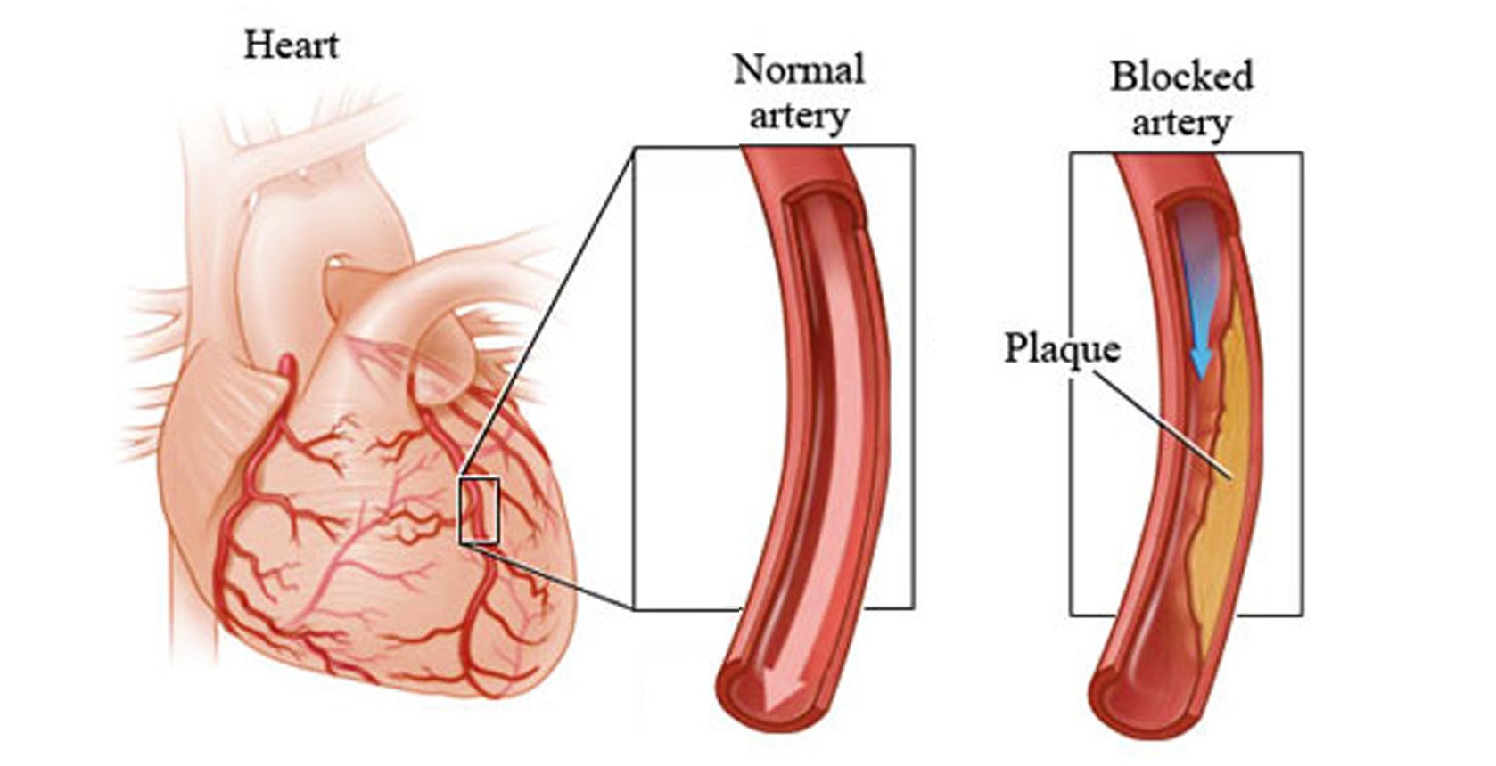 You are currently viewing 7 Early Warning Signs Of Heart Attack You Shouldn’t Ignore