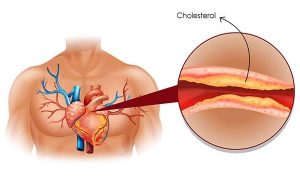 Read more about the article Eat These Foods To Reduce Cholesterol Levels In Your Blood