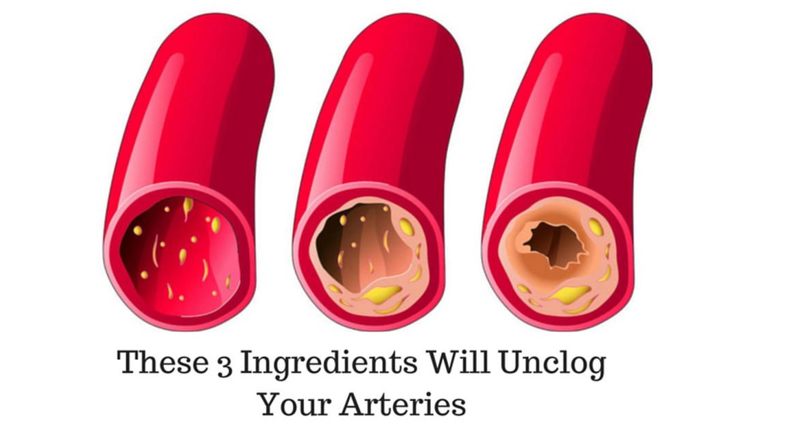 You are currently viewing Coronary Arteries Cleanse With Only 3 Ingredients