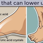 8 Foods That Can Lower Uric Acid