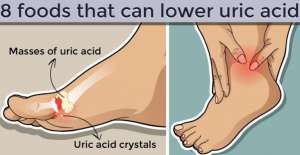 Read more about the article 8 Foods That Can Lower Uric Acid