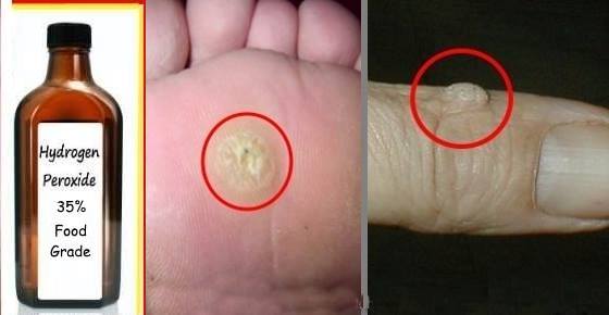 You are currently viewing How to Easily Remove Warts And Skin Tags With Hydrogen Peroxide