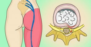 Read more about the article How to Release the Pinched Nerve in the Lumbar Area (sciatica)- 5 Simple Ways to Get Rid of the Pain