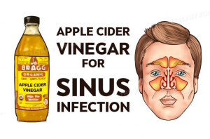 Read more about the article How To Kill Sinus Infection Within Minutes With Apple Cider Vinegar!