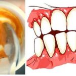 This Homemade Toothpaste Reverses Gum Disease and Whitens Teeth!