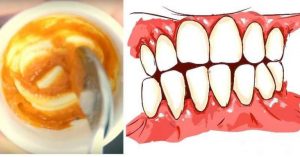 Read more about the article This Homemade Toothpaste Reverses Gum Disease and Whitens Teeth!