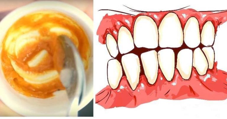 You are currently viewing This Homemade Toothpaste Reverses Gum Disease and Whitens Teeth!