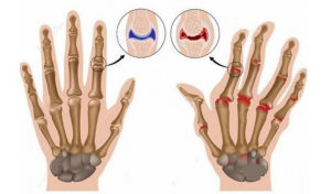 Read more about the article Find Out About This 3,000-Year-Old Technique For Treating Rheumatoid Arthritis And Inflammation