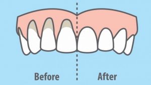 Read more about the article 10 Easy Ways to Heal Receding Gums Naturally