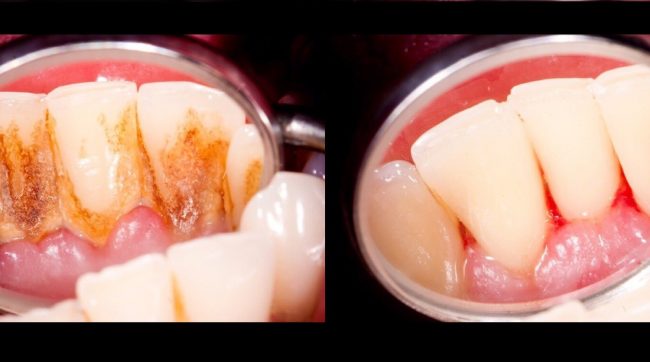 You are currently viewing 4 Mixtures That Completely Remove Plaque From Your Teeth