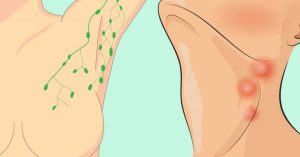 Read more about the article 16 Signs There’s A Toxic, Congested Lymph In The Body And How To Help Drain It