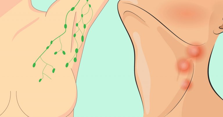 You are currently viewing 16 Signs There’s A Toxic, Congested Lymph In The Body And How To Help Drain It