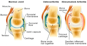 Read more about the article The Best Medicine for Joint Problems, Arthritis, Osteoporosis and Rheumatism