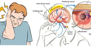 Read more about the article Here is How To Instantly Stop A Migraine With Salt