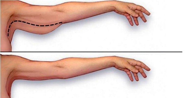 You are currently viewing 7 Exercises to Lose Arm Fat at Home