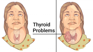 Read more about the article 11 Foods That Significantly Improve Your Thyroid Health and Help You Treat Thyroid Problems