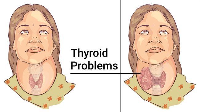 You are currently viewing 11 Foods That Significantly Improve Your Thyroid Health and Help You Treat Thyroid Problems