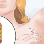 7 Easy Ways to Remove Skin Tags Without Seeing a Doctor