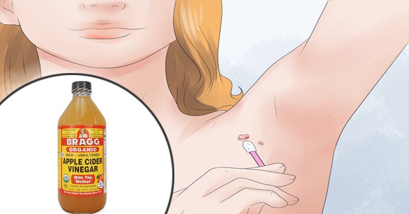 You are currently viewing 7 Easy Ways to Remove Skin Tags Without Seeing a Doctor