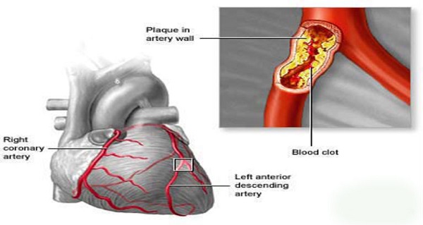 You are currently viewing Save Your Heart, Kidneys, and Brain: Clean Your Arteries With These 3 ingredients