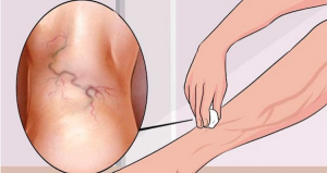 Read more about the article Get Rid of Varicose Veins Forever With The Use of One Simple Ingredient!