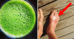 Read more about the article How to Remove Uric Acid Crystallization in Joints for Gout and Joint Pain