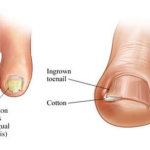 How to Get Rid of Toenail Fungus Using Just 3 Simple Home Remedies