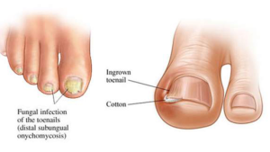 Read more about the article How to Get Rid of Toenail Fungus Using Just 3 Simple Home Remedies