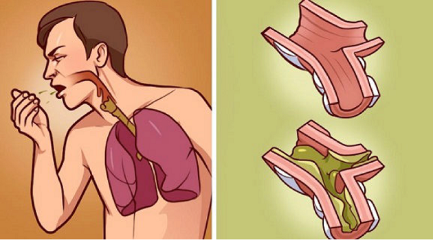 You are currently viewing When Your Lungs Drown in Mucus, This is The Best Cure! It’s 100% Natural and Works in Just Few hours!