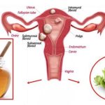 Mix These 2 Ingredients and Destroy Any Cysts and Fibroids