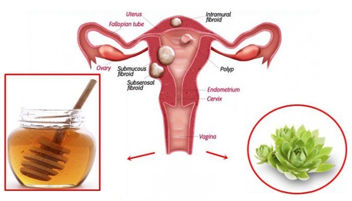You are currently viewing Mix These 2 Ingredients and Destroy Any Cysts and Fibroids