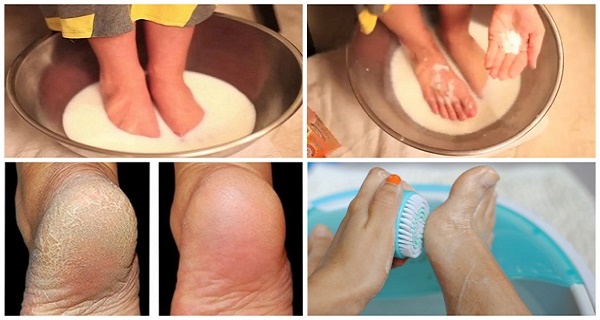 You are currently viewing Don’t Waste Your Money on Pedicure Anymore: Just Two Ingredients from Your Kitchen Can Make Your Feet Look Amazing!