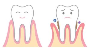 Read more about the article These 4 Natural Remedies Will Repair Receding Gums