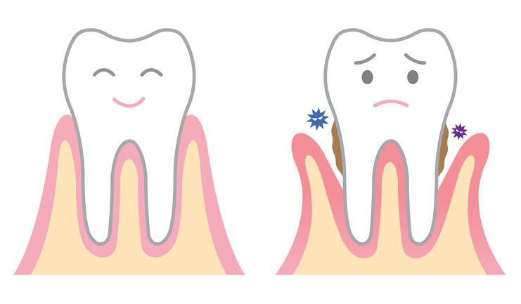 You are currently viewing These 4 Natural Remedies Will Repair Receding Gums